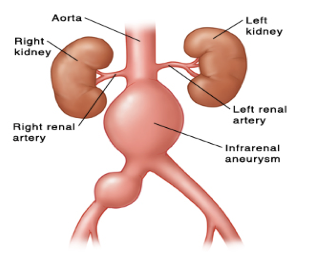 EmDOCs Emergency Medicine EducationAbdominal Aortic Aneurysm 