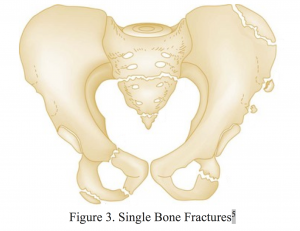 superior pubic ramus fracture