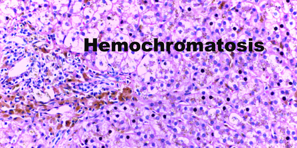hemochromatosis histology