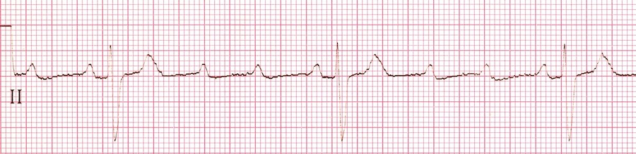 Icd 10 For High Grade Av Block