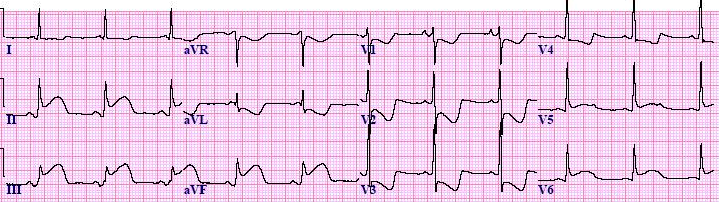 EmDOCs Net Emergency Medicine Educationpost Inferioposteriorstemi