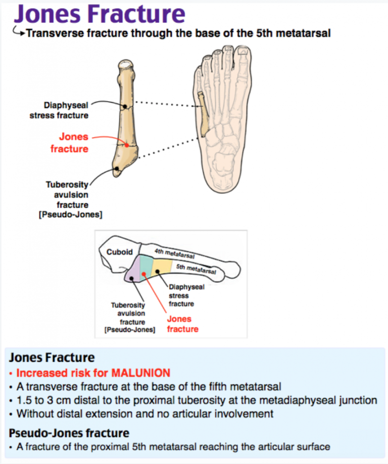 Emdocs Net Emergency Medicine Educationem Am Th Metatarsal Fractures Emdocs Net