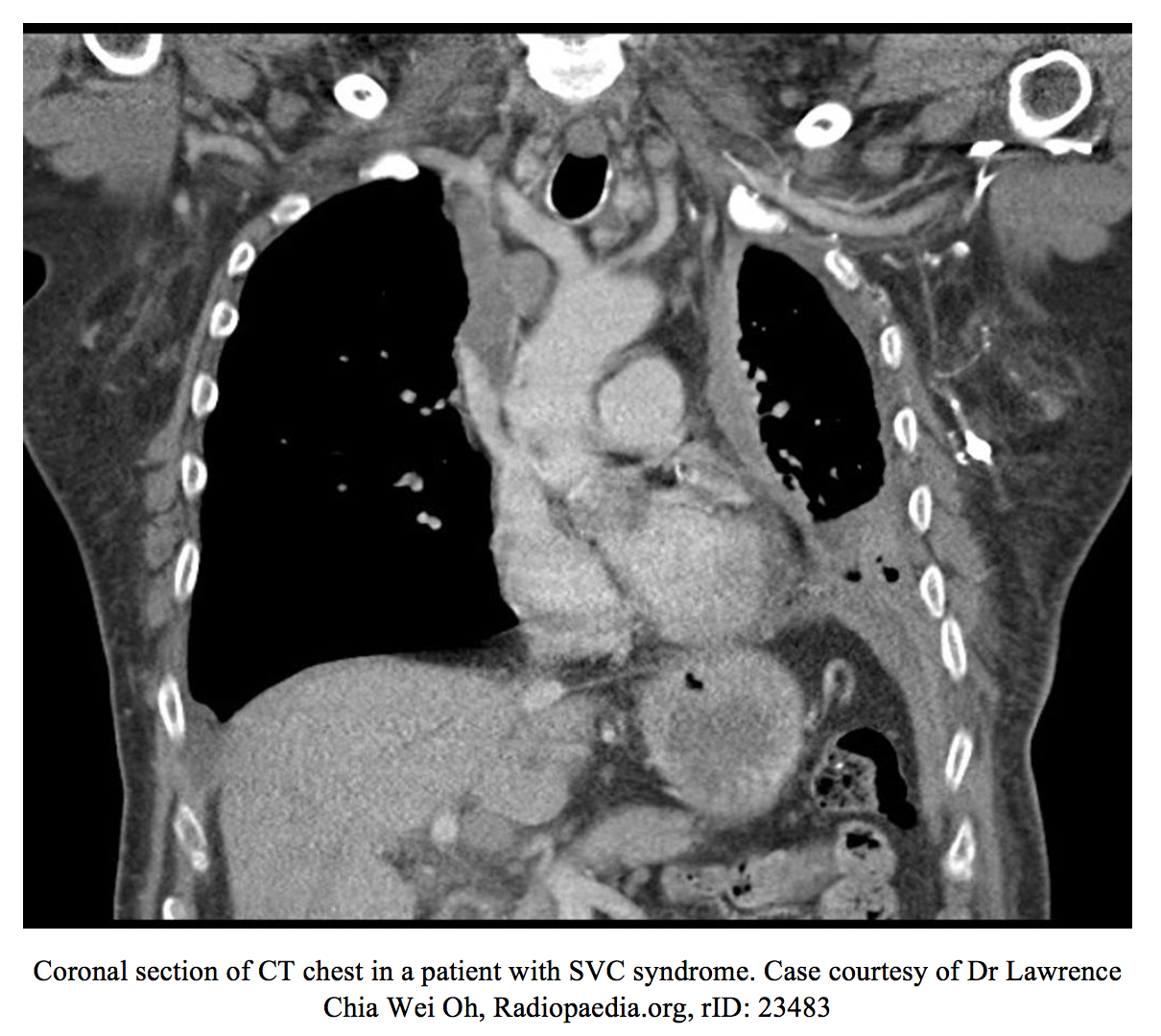 EmDOCs Net Emergency Medicine EducationFacial Swelling Etiologies Presentations Evaluation