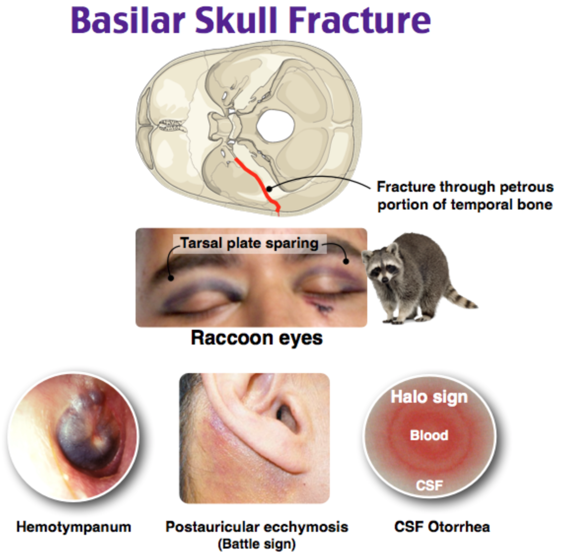 basilar skull fracture xray