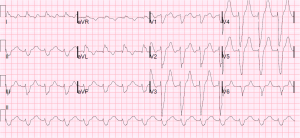 View Sinus Rhythm With Bundle Branch Block Strip PNG