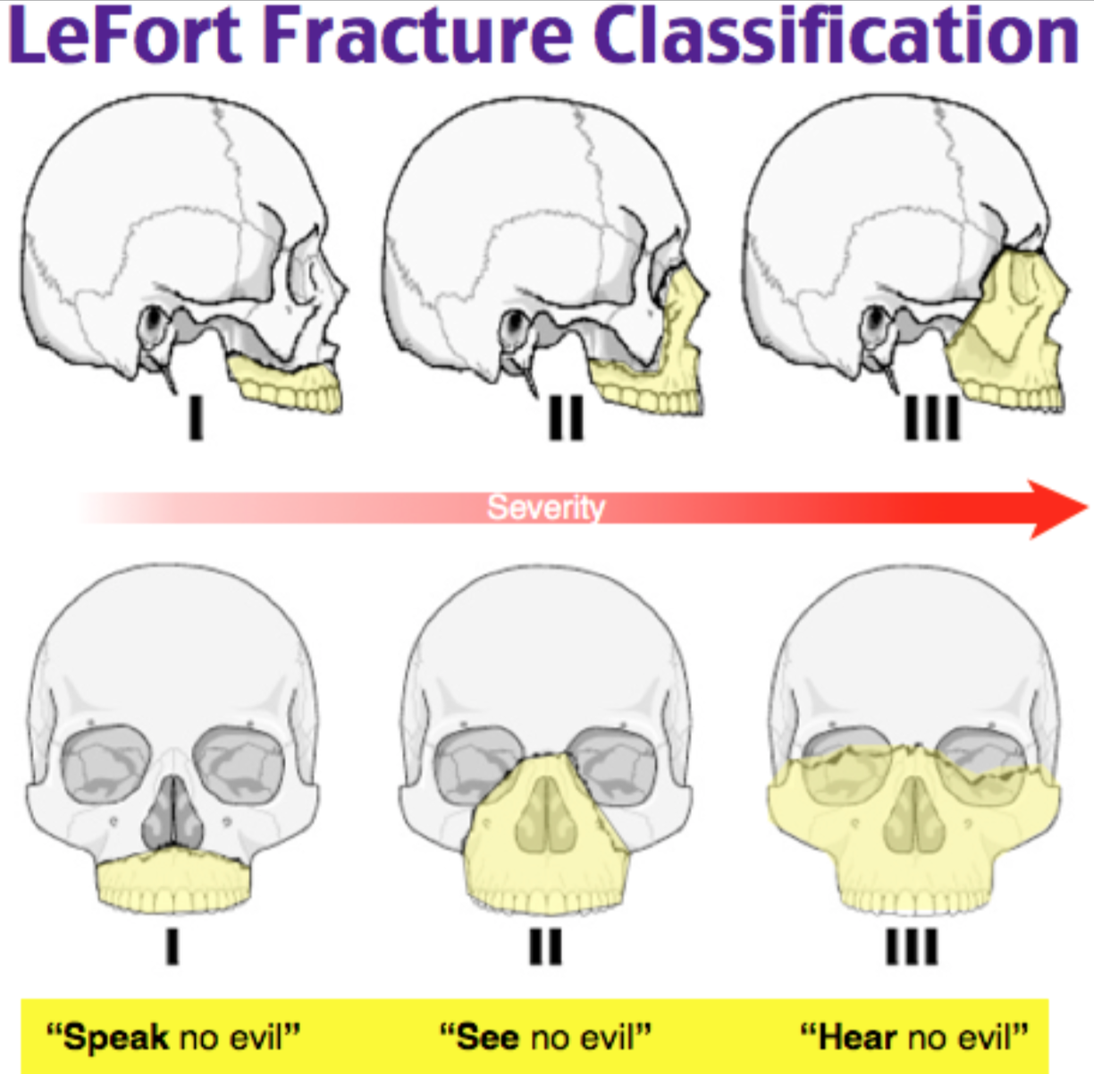 le fort fracture complications
