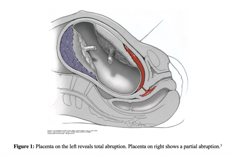 EmDOCs Net Emergency Medicine EducationEM 3AM Placental Abruption