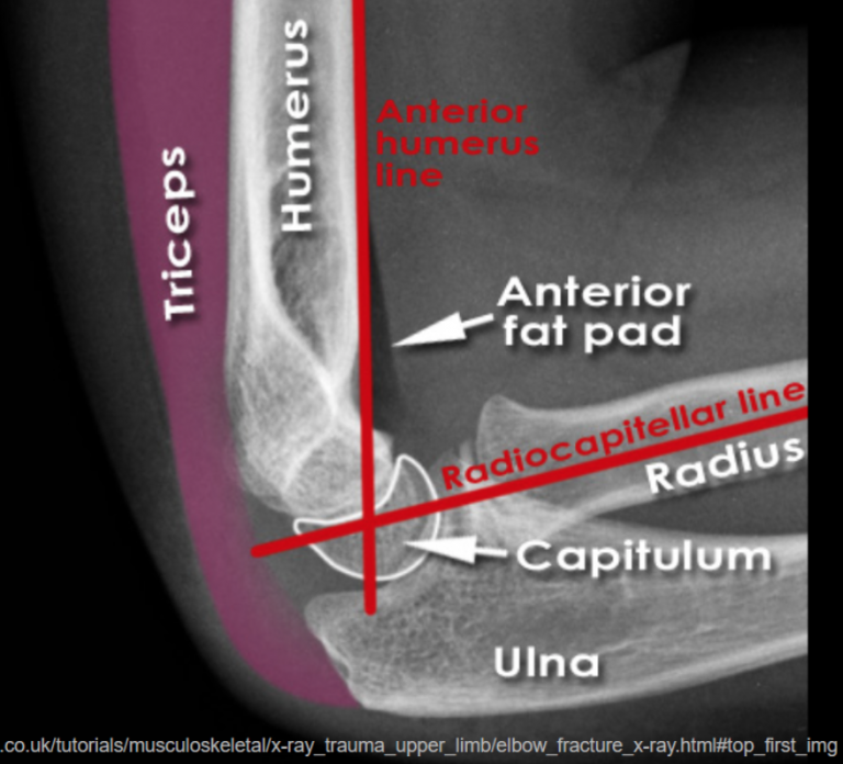 emDOCs.net – Emergency Medicine EducationEM in 5: Elbow Xrays - emDOCs