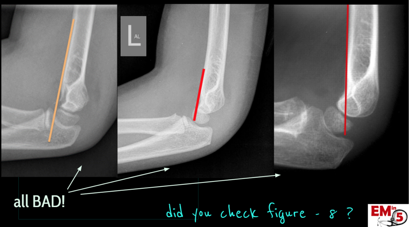 Emdocs Net Emergency Medicine Educationem In Elbow Xrays Emdocs Net Emergency Medicine