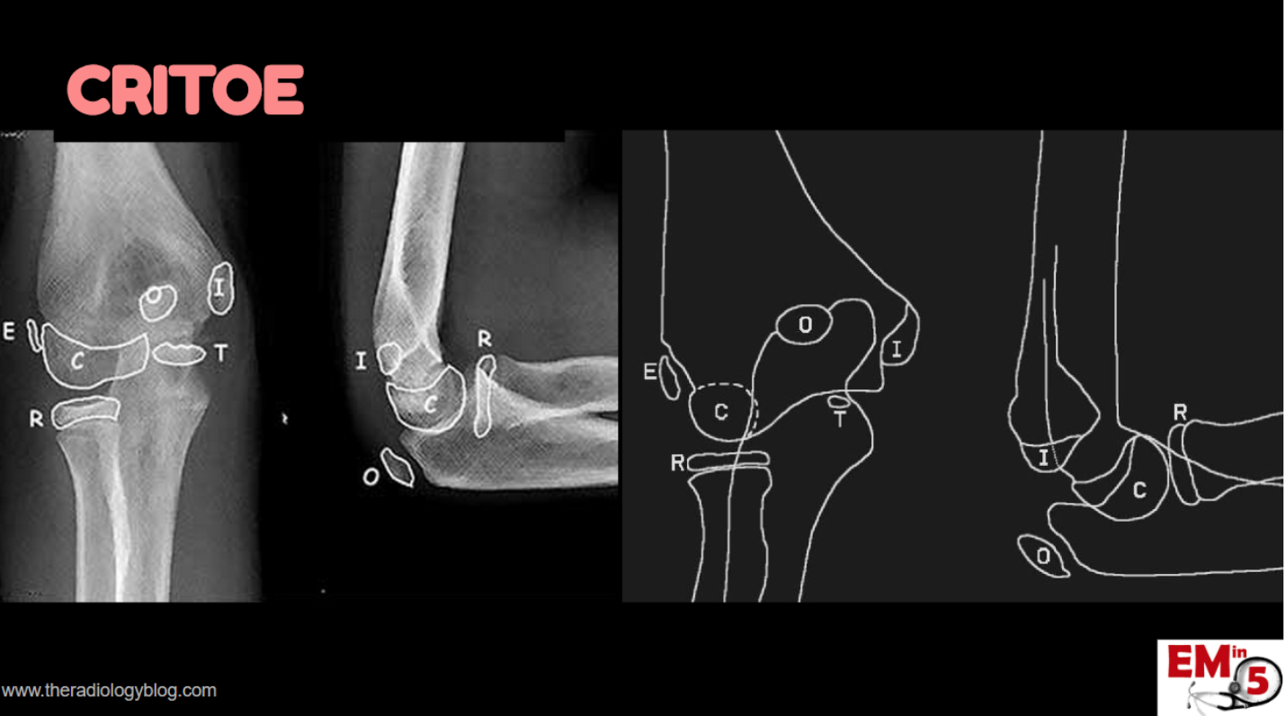 Emergency Medicine Educationem In 5 Elbow Xrays Emergency Medicine 7439