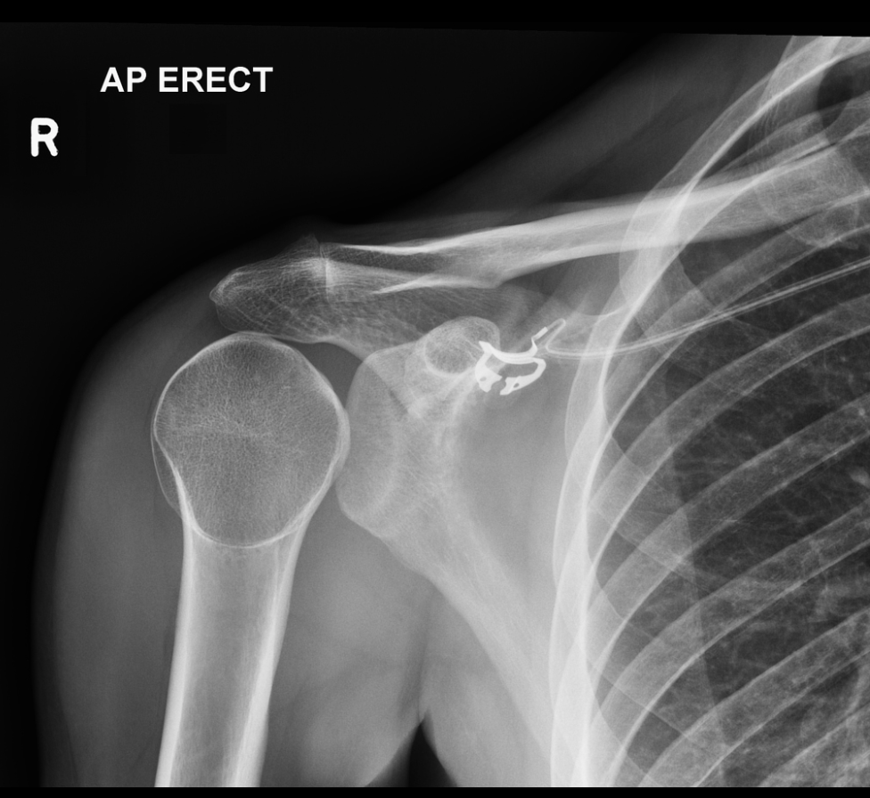 EmDOCs.net – Emergency Medicine EducationEM@3AM: Anterior Shoulder ...