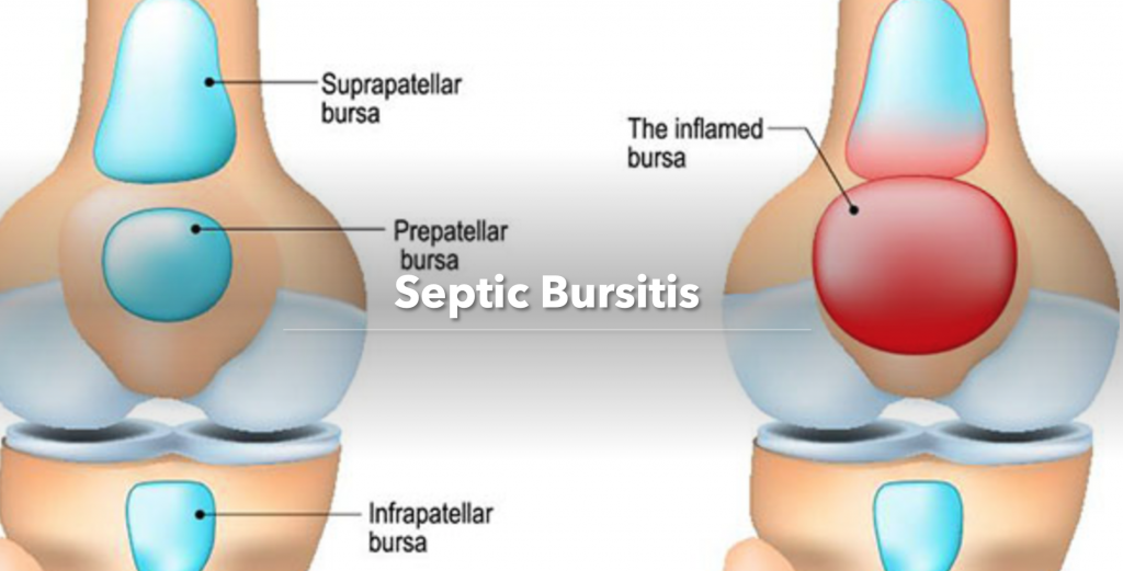 what causes septic bursitis