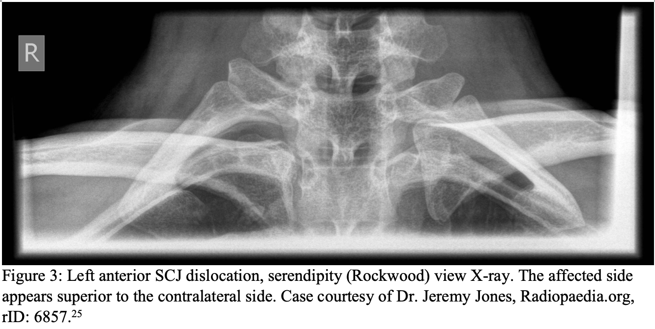 Emergency Medicine Educationsternoclavicular Dislocation