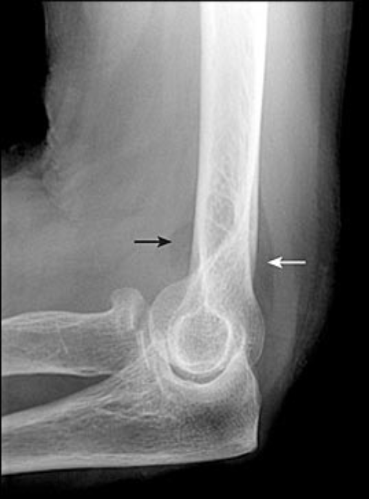 occult radial head fracture