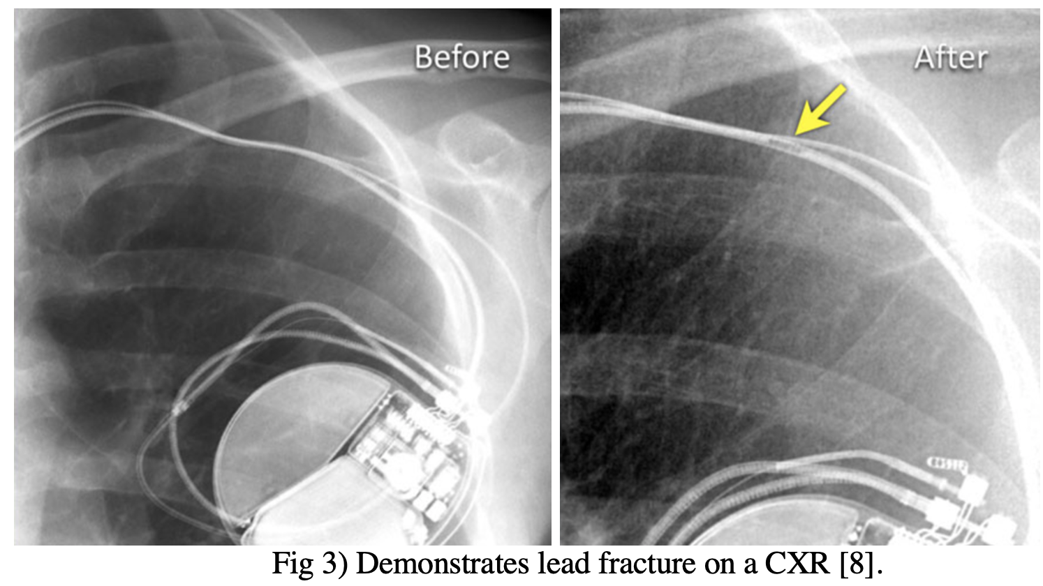 transvenous pacemaker failure to capture