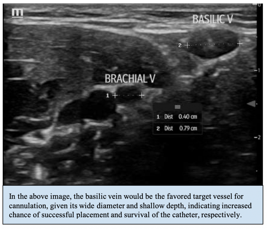 Emergency Medicine Educationemdocs Podcast Episode 28 Difficult Vascular Access 0311