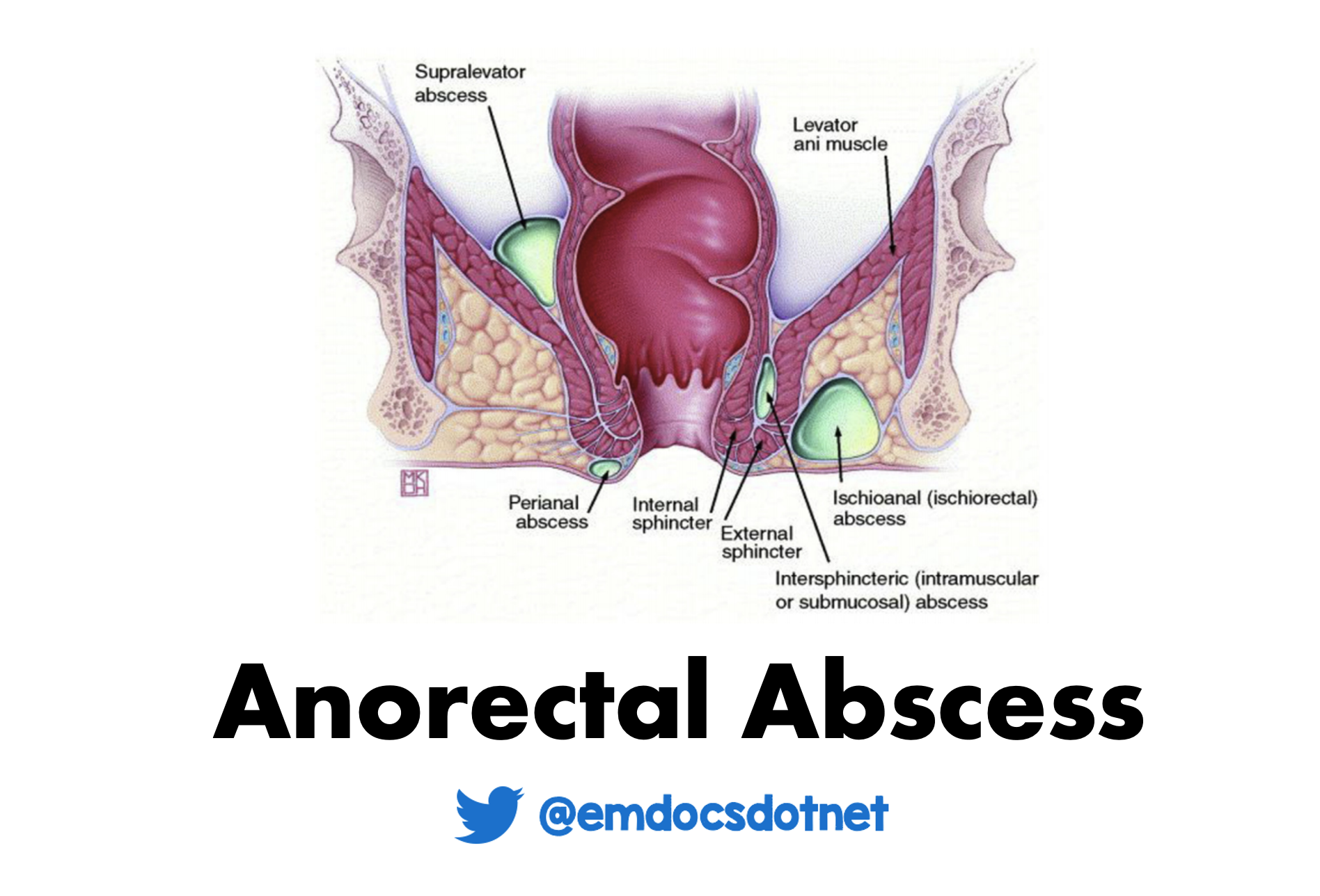 EmDOCs Emergency Medicine EducationAnorectal Abscesses ED 