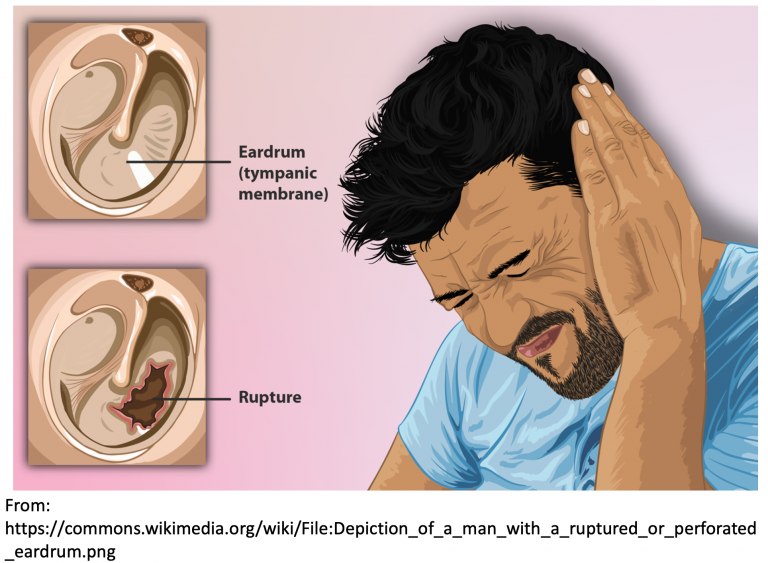 barotrauma ear
