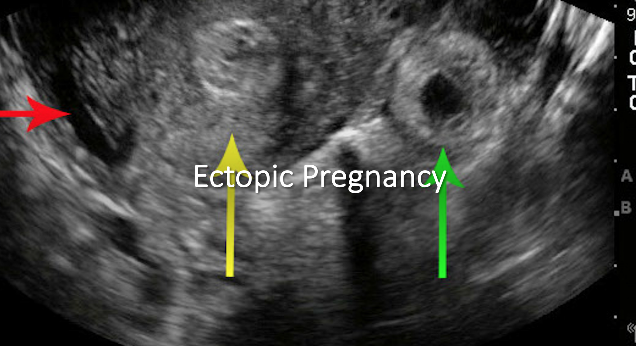 are-pregnancy-tests-accurate-5-days-after-missed-period-lasopakb