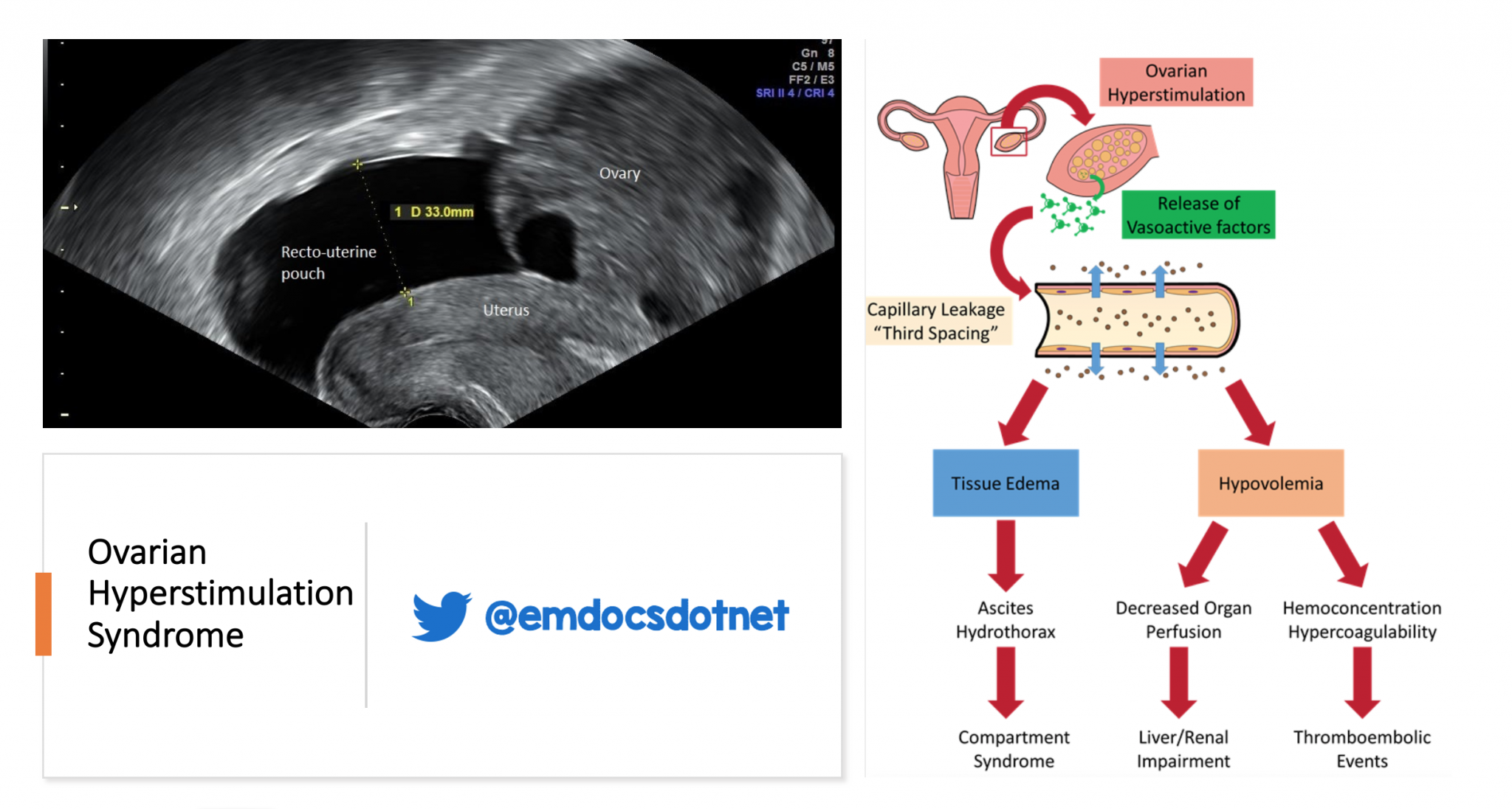 EmDOCs.net – Emergency Medicine EducationemDOCs Podcast - Episode 31 ...