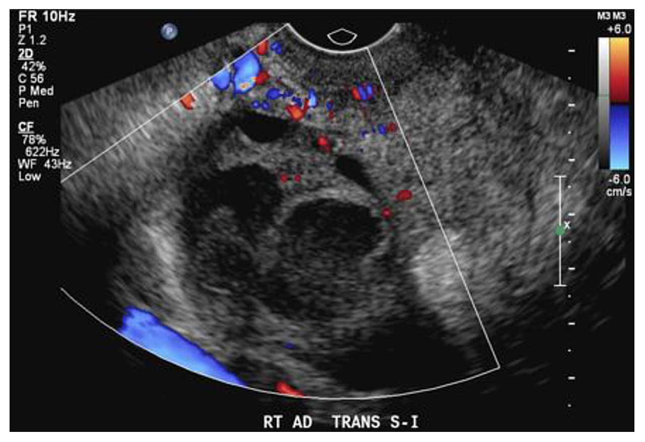 EmDOCs.net – Emergency Medicine EducationPelvic Ultrasound: Indications ...