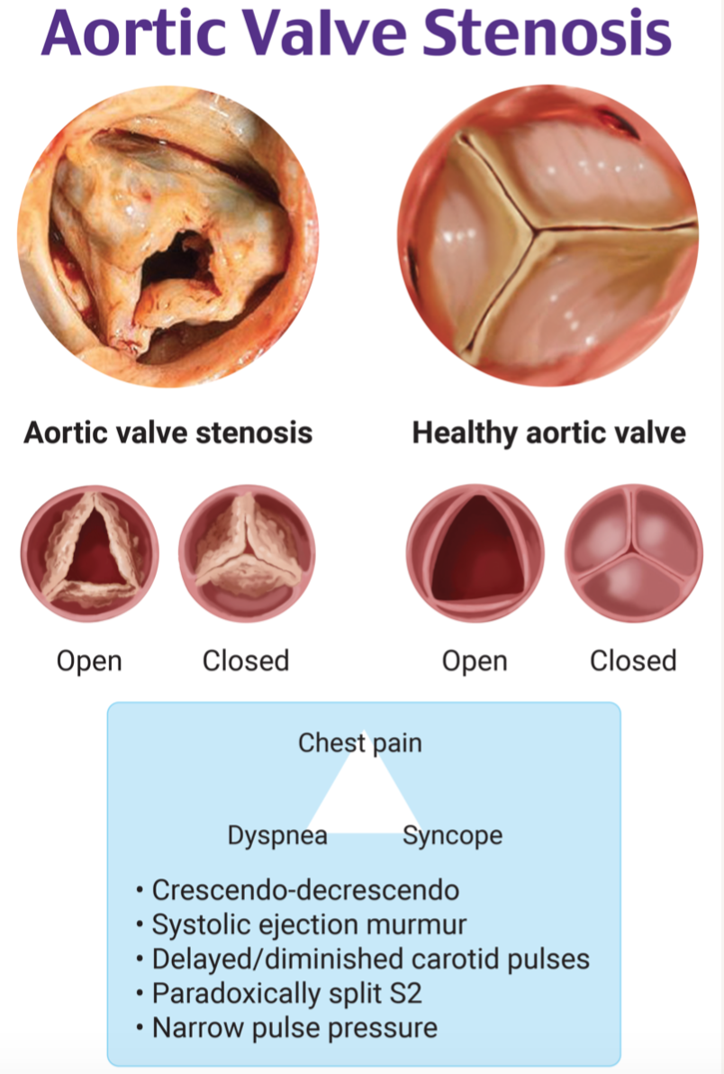 Emdocs Net Emergency Medicine Educationem Am Aortic Stenosis