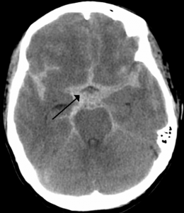 emDOCs.net – Emergency Medicine EducationUnusual Stroke Presentations ...