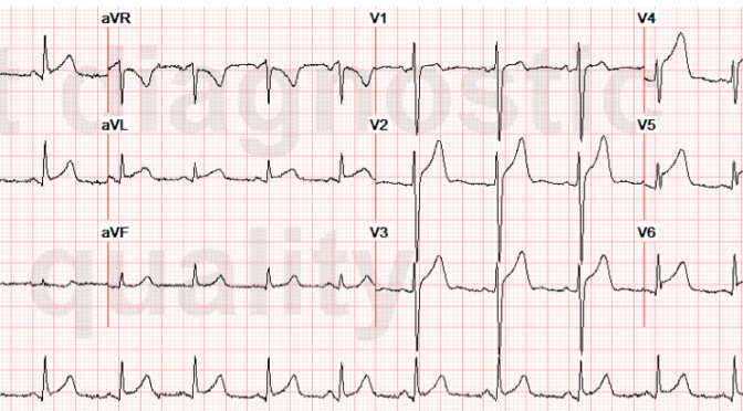 spontaneous coronary artery dissection Archives - emdocs