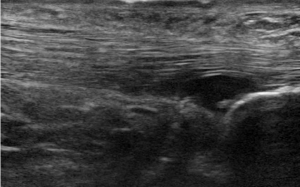 emDOCs.net – Emergency Medicine EducationUltrasound for Achilles Tendon ...