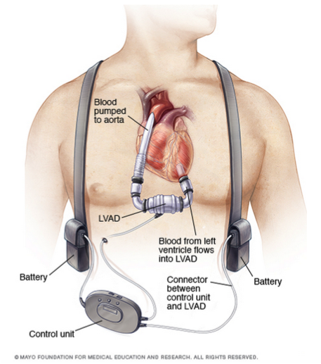 LVAD setup