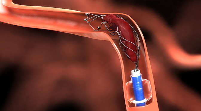 Endovascular Stroke Therapy: Is This the New Standard? - emdocs