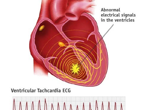 Refractory Ventricular Tachycardia: Approach to Management - emdocs