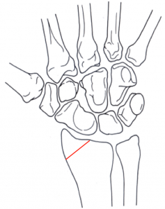 emDOCs.net – Emergency Medicine EducationWrist and Distal Forearm ...