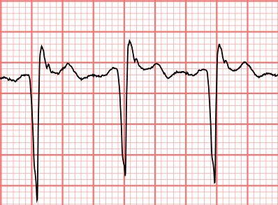 emDOCs.net – Emergency Medicine EducationSubtle ECG Findings in ACS ...