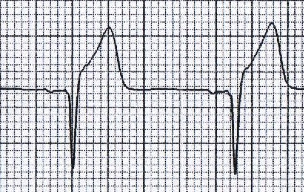 emDOCs.net – Emergency Medicine EducationSubtle ECG Findings in ACS ...