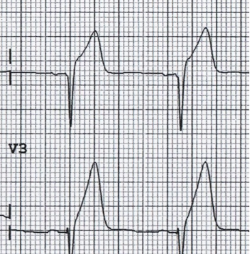 Atypical STEMI Patterns and STEMI Equivalents - emdocs