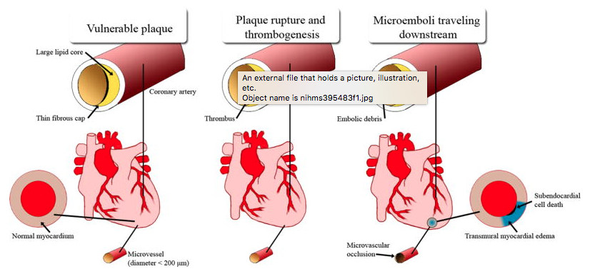 NSTEMI path