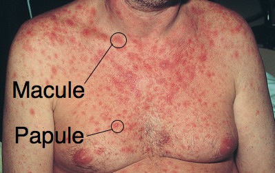 maculopapular