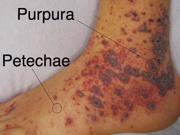 petechiae purpura
