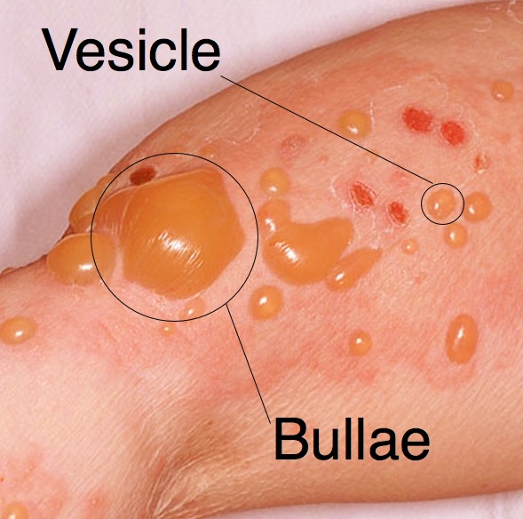 vesiculobullous