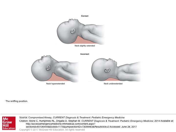 Emdocs Net Emergency Medicine Educationsniffing Position Emdocs Net