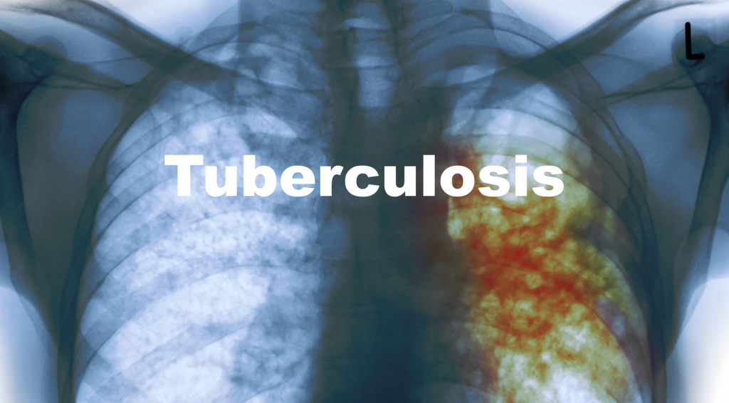 emDOCs.net – Emergency Medicine EducationTuberculosis: Presentation and ...