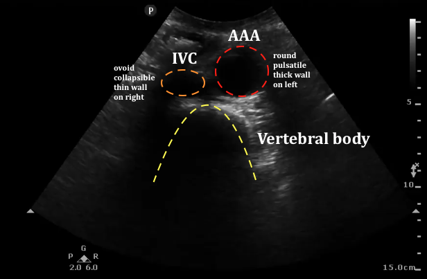 Aortic Aneurysm Ultrasound