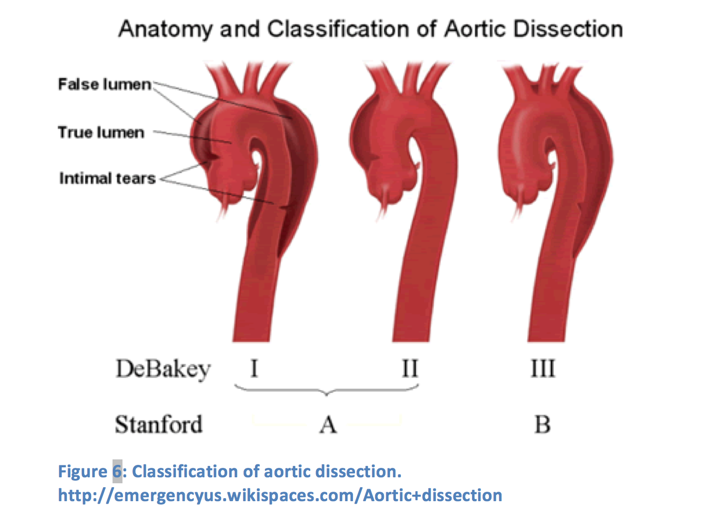 Типы аневризм аорты по Дебейки. Диссекция аорты 3 Тип по Дебейки. Типы расслоения аорты по Дебейки. Диссекция аорты 1 типа по Дебейки.