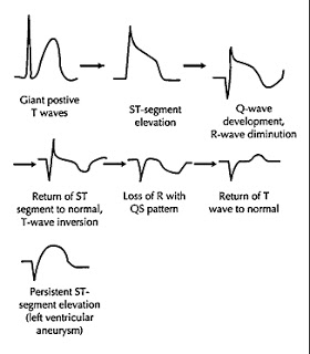 emDOCs.net – Emergency Medicine EducationECG Pointers: Hyperacute T ...