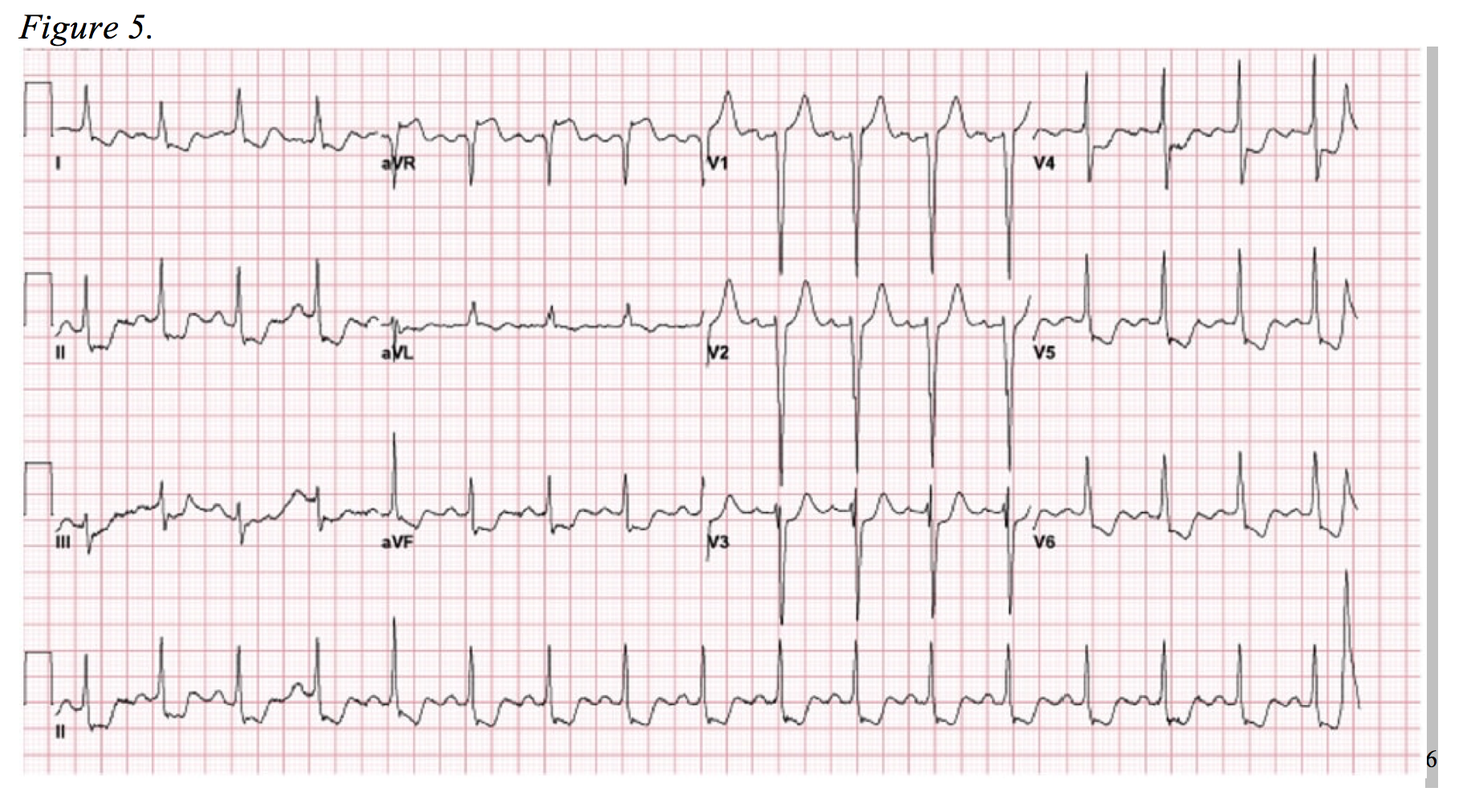 emDOCs.net – Emergency Medicine EducationNSTEMI Mimics: A Review of ...