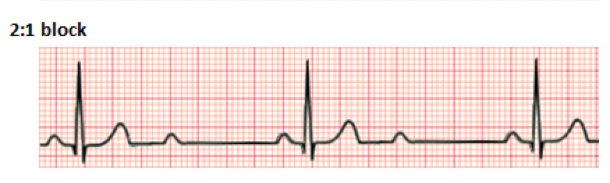 emDOCs.net – Emergency Medicine EducationECG Pointers: AV blocks - Part ...