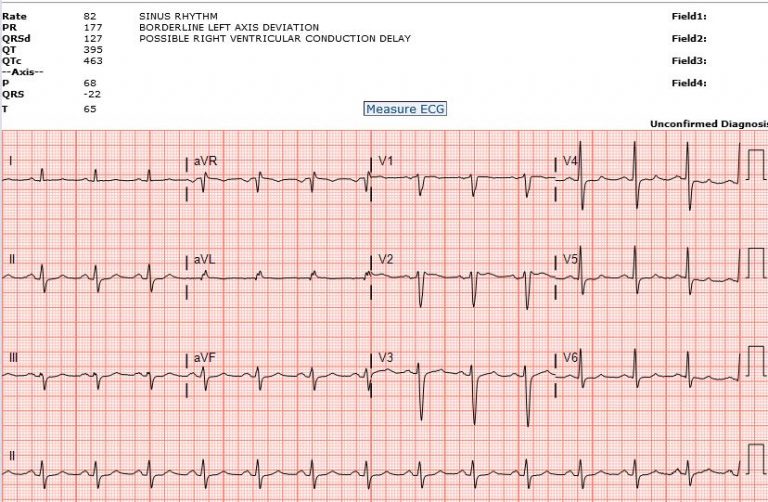 emDOCs.net – Emergency Medicine EducationECG Pointers: TCA Overdose ...