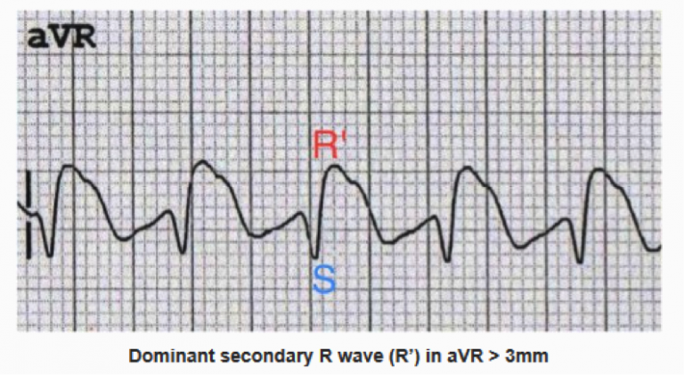 emDOCs.net – Emergency Medicine EducationECG Pointers: TCA Overdose ...