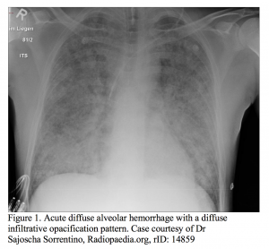 emDOCs.net – Emergency Medicine EducationGoodpasture’s syndrome (anti ...